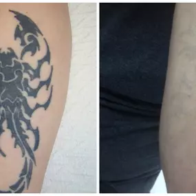 Bild von East Coast Laser Tattoo Removal