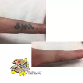 Bild von East Coast Laser Tattoo Removal