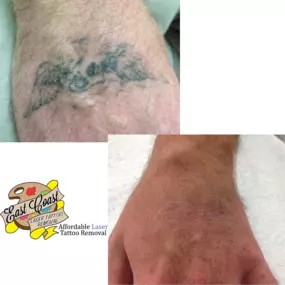 Bild von East Coast Laser Tattoo Removal