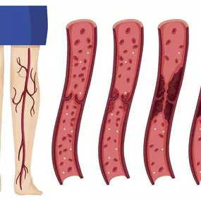 Deep Vein Thrombosis