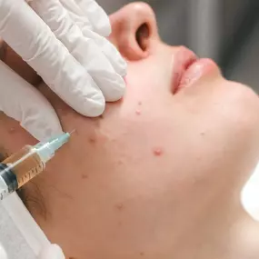 A close-up of a person's face receiving an injection, likely for a skin treatment, into the cheek area, showing a clear syringe with amber liquid and small blemishes on the skin.
