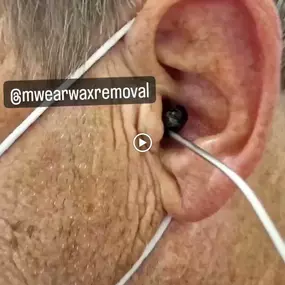 Bild von MW Ear Wax Removal