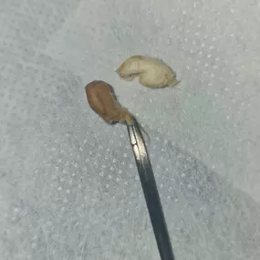 Bild von MW Ear Wax Removal