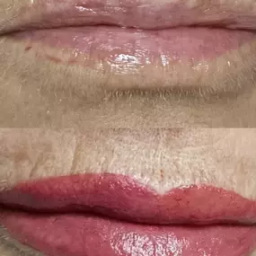 micro-labios-fuengirola.jpg