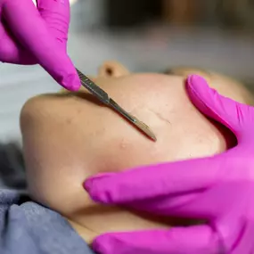 Dermaplaning in Palm Beach Gardens FL