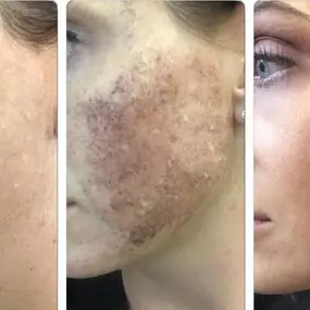 Plasma fibroblast skin tightening Palm Beach Gardens