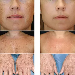 Where to get flawless skin Palm Beach Gardens