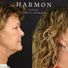Bild von Harmon Facial Plastic Surgery