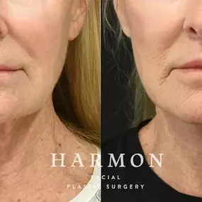 Bild von Harmon Facial Plastic Surgery
