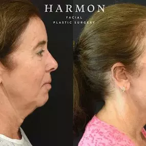 Bild von Harmon Facial Plastic Surgery