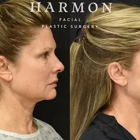 Bild von Harmon Facial Plastic Surgery