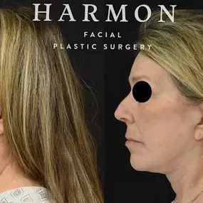 Bild von Harmon Facial Plastic Surgery