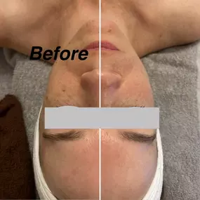 Friolift Facial