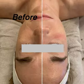 Friolift Facial