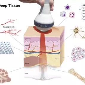 Lasertherapie apeldoorn