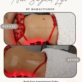 Stomach Lipo