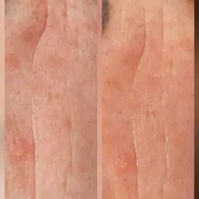 MOÈ Nails & Beauty Hautbehandlung in Augsburg mit sichtbaren Anti-Aging-Effekten für glatte Haut.