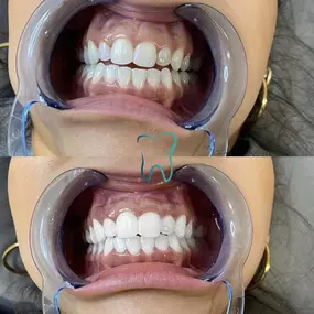 Bild von zahnaufhellungwien