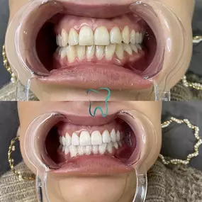 Bild von zahnaufhellungwien