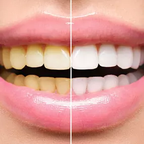 Bild von zahnaufhellungwien