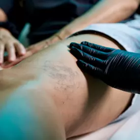 Medicus Aesthetics in Jupiter, FL specializes in spider vein treatment using advanced sclerotherapy techniques. Our physician-led team helps patients restore clear, healthy legs with safe, effective, non-surgical care. Book a consultation today and experience lasting results.