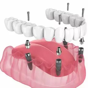 dentist Arlington Heights implants