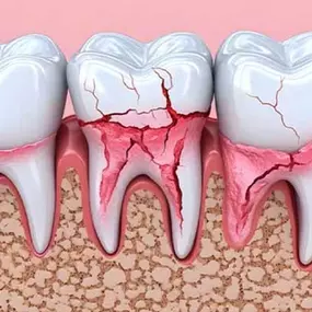dentist Arlington Heights cracked tooth