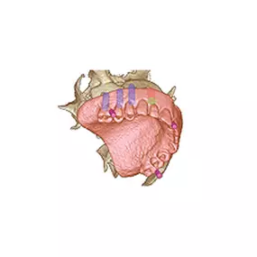 CODIAGNOSTIX™ – DIE DENTAL WINGS SOFTWARE FÜR DIE VIRTUELLE 3D-IMPLANTAT-NAVIGATION