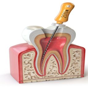 Wurzelbehandlung  - Zahnarztpraxis Stefan von Ostranitza |  Zahnarzt Zahnersatz Parodontologie | München