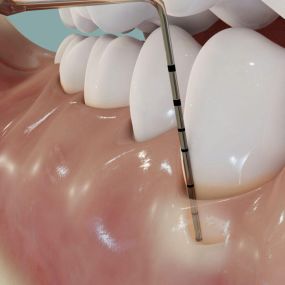 Parodontologie - Zahnarztpraxis Stefan von Ostranitza |  Zahnarzt Zahnersatz Parodontologie | München
