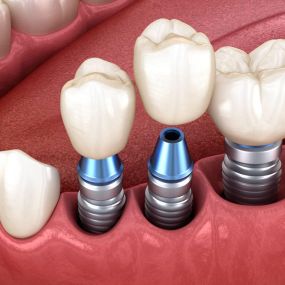 Implantatberatung - Zahnarztpraxis Stefan von Ostranitza |  Zahnarzt Zahnersatz Parodontologie | München