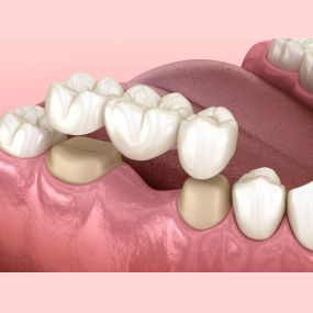 Zahnersatz - Zahnarztpraxis Stefan von Ostranitza |  Zahnarzt Zahnersatz Parodontologie | München