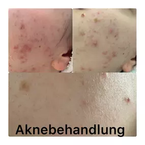 Voher-Nachher Vergleich Aknebehandlung mit Needling und besten Wirkstoffen, Akne Behandlung, Akne loswerden mit Needling, Pickel bahandeln, Entfernen, lindern, Hautspezialistin Bad Langensalza, Erfurt, Gotha, Mühlhausen, Eisenach, Nordhausen