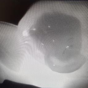 DiagnoCam Lichtkamera, leuchtet durch den Zahn und man sieht schon minimale Karies