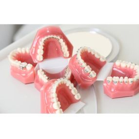 Es gibt verschieden Arten der Zahnspange