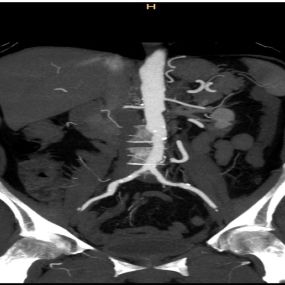 CT Angio Aorta abdominalis