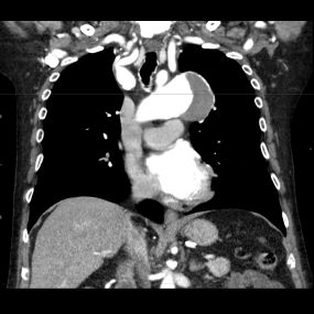 CT Angiographie Aortenaneurysma