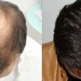 Transplantieren schonend Haare Basel Region Narben Haartransplantation
