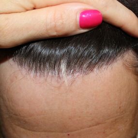 Transplantieren schonend Haare Basel Region Narben Haartransplantation