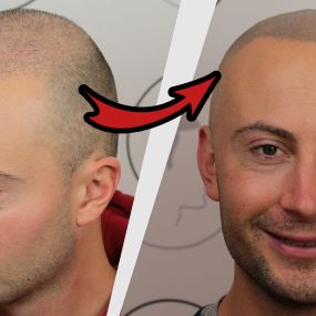 Bild von Haarpigmentierung | Modern Hair Loss Solution