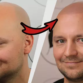 Bild von Haarpigmentierung | Modern Hair Loss Solution