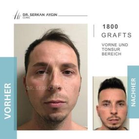 Bild von Dr Serkan Aygin | Niederlassung Köln | Haartransplantation Türkei