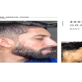 Bild von Dr Serkan Aygin | Niederlassung Köln | Haartransplantation Türkei