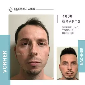 Bild von Dr Serkan Aygin | Niederlassung Köln | Haartransplantation Türkei