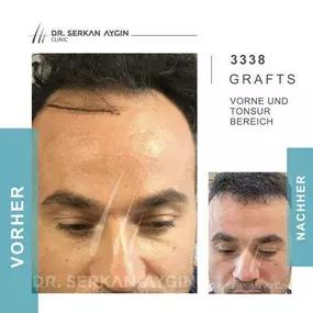 Bild von Dr Serkan Aygin | Niederlassung Köln | Haartransplantation Türkei