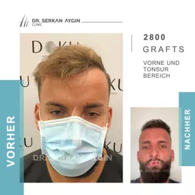 Vorher Nachher Ergebnis - Dr. Serkan Aygin Clinic Turkey