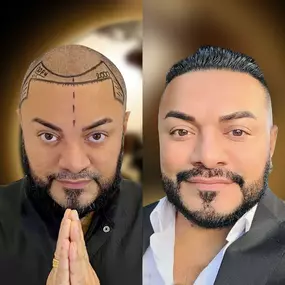 Bild von Asli Tarcan Clinic | Haartransplantationen in der Türkei Istanbul