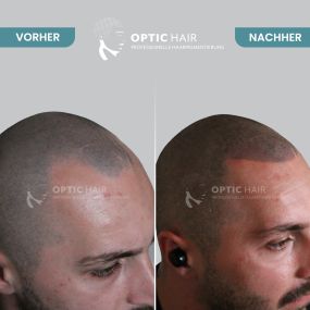 Haarpigmentierung Vorher Nachher Bilder Optic Hair