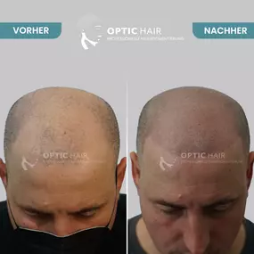 Haarpigmentierung Vorher Nachher Bilder Optic Hair