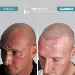 Haarpigmentierung Vorher Nachher Bilder Optic Hair